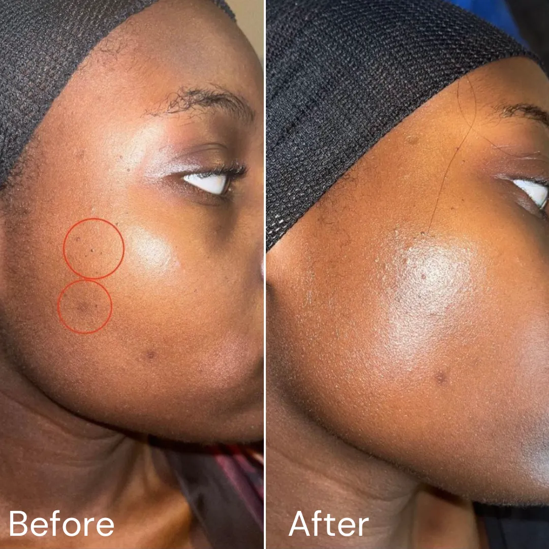 Total Acne Solution 4-step acne fighting system