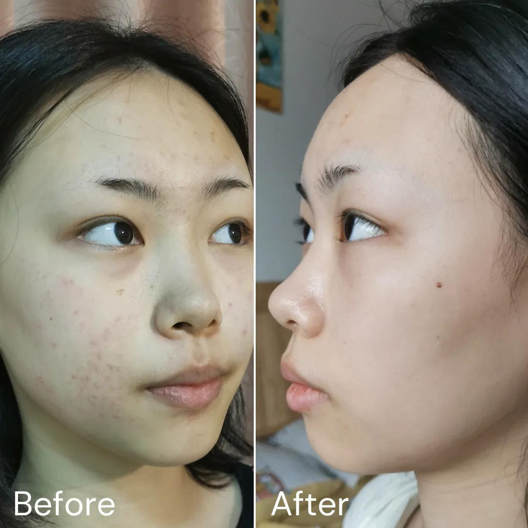 Total Acne Solution 4-step acne fighting system